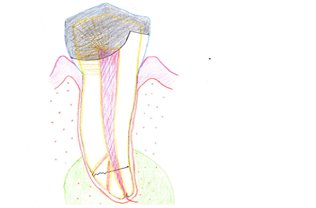 What To Do After Root Canal Treatment